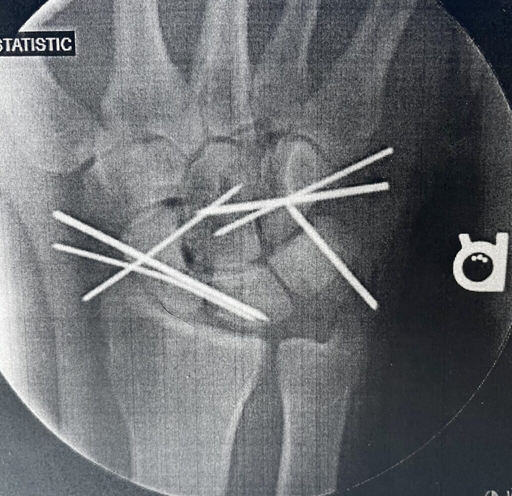 Fluoroscopic X-ray of a wrist showing four surgical pins crossing through the carpal bones after fracture repair