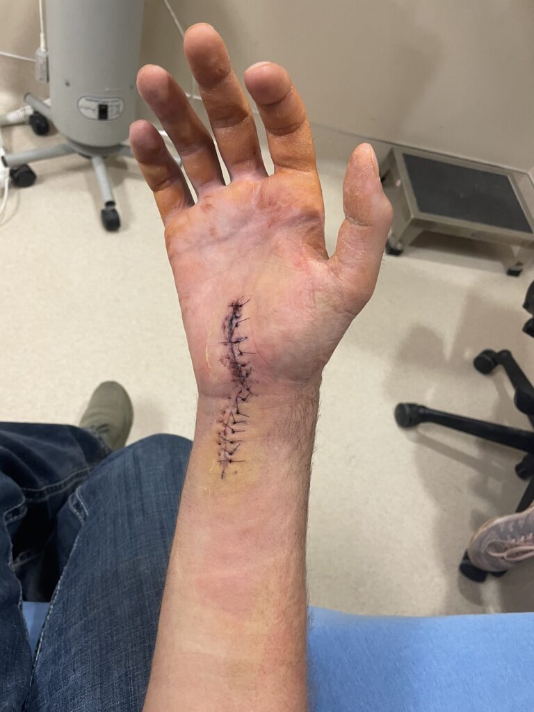 Sutured surgical incision running from the palm across the wrist onto the forearm of a hand held up in a clinic room