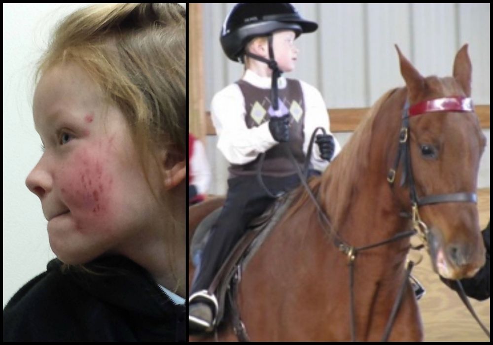 Side-by-side of a young girl with scraped, bruised cheek and the same child in helmet and vest riding a chestnut horse